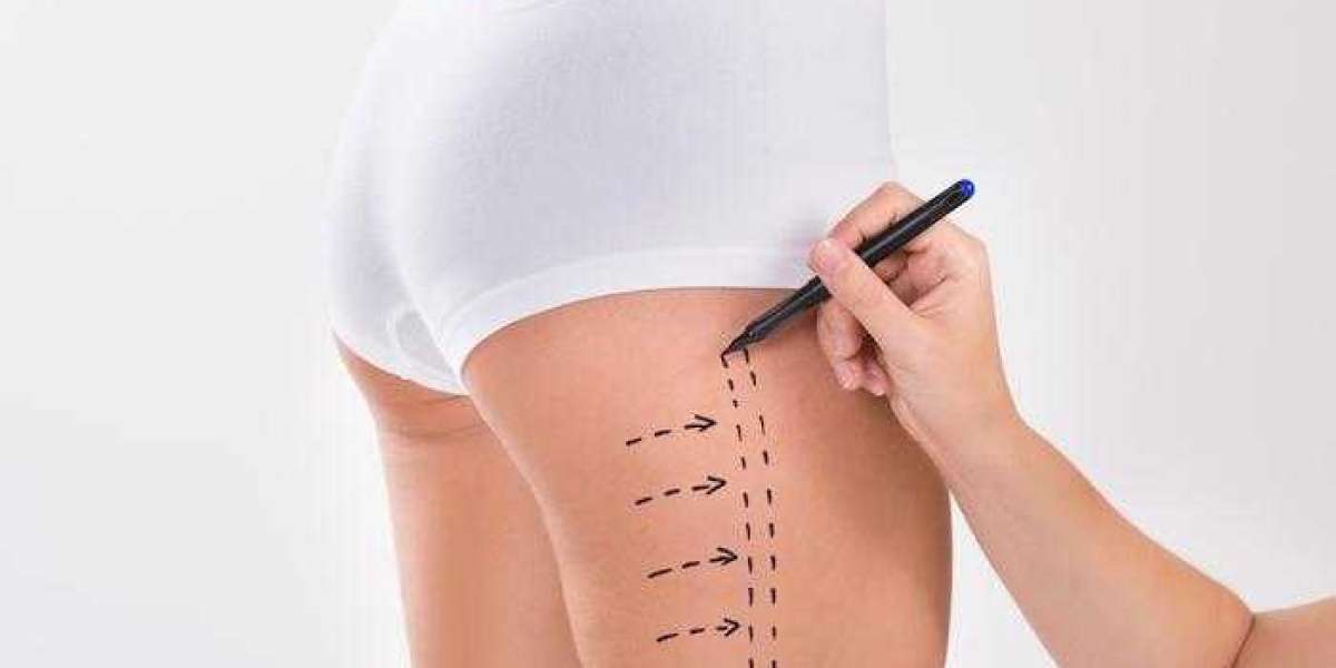 Maintaining Long Term Results After Liposuction
