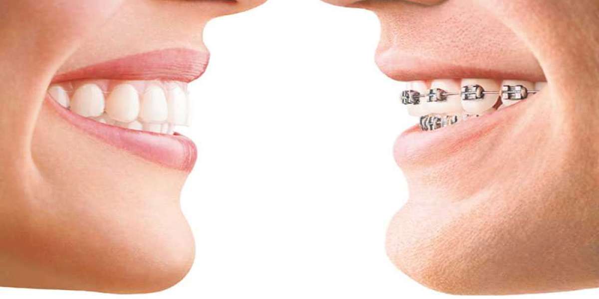 The Complete Guide to Teeth Braces: Everything You Need to Know