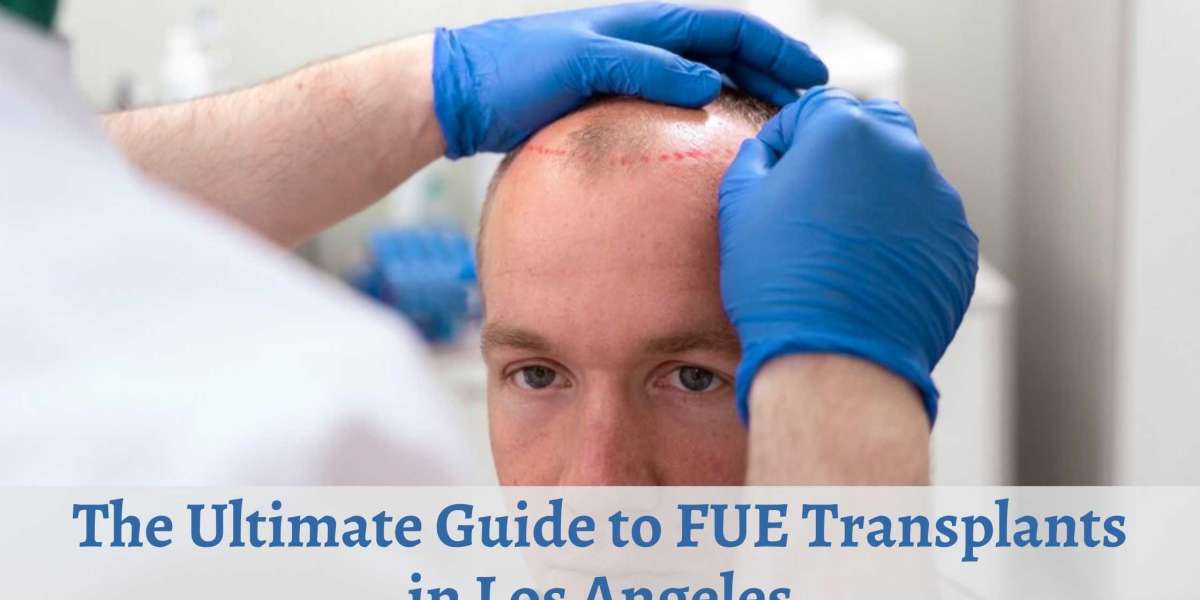 The Ultimate Guide to FUE Transplants in Los Angeles
