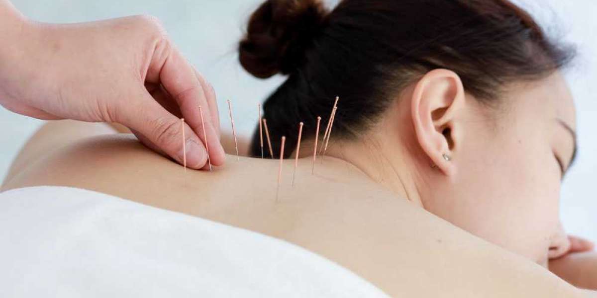 Supporting Your IVF Journey with Acupuncture: A Natural Boost