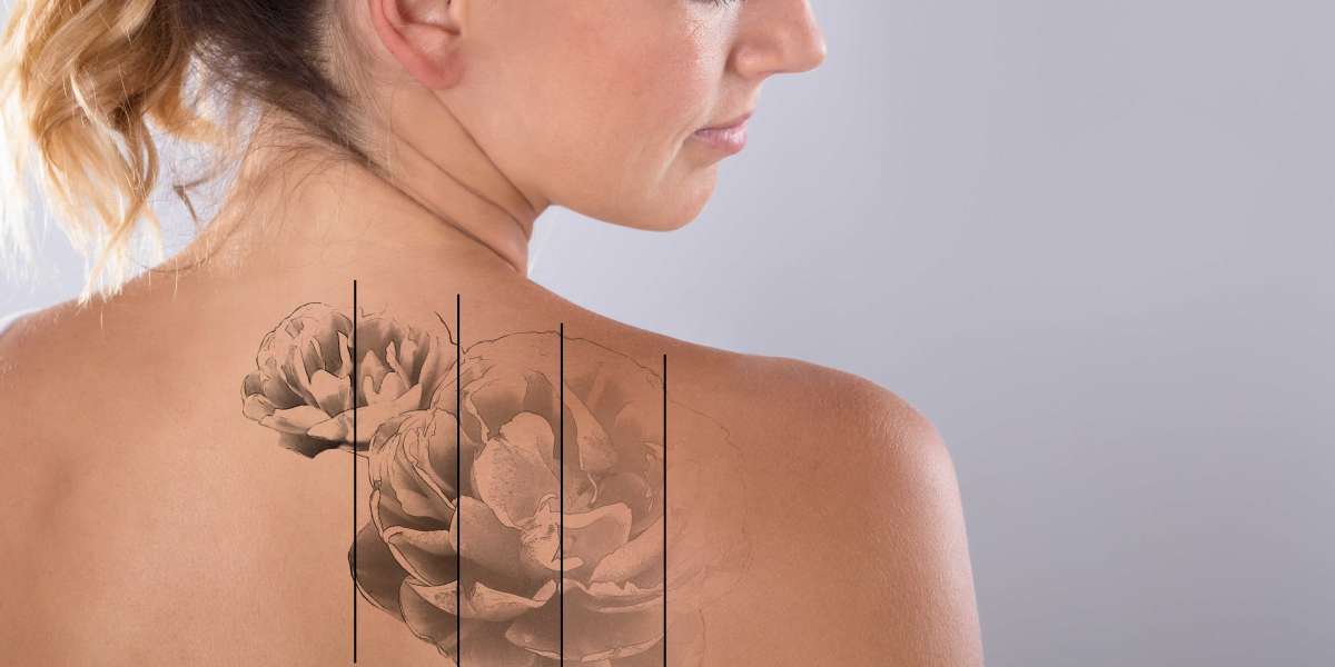 Will Laser Tattoo Removal Affect Hair Growth?