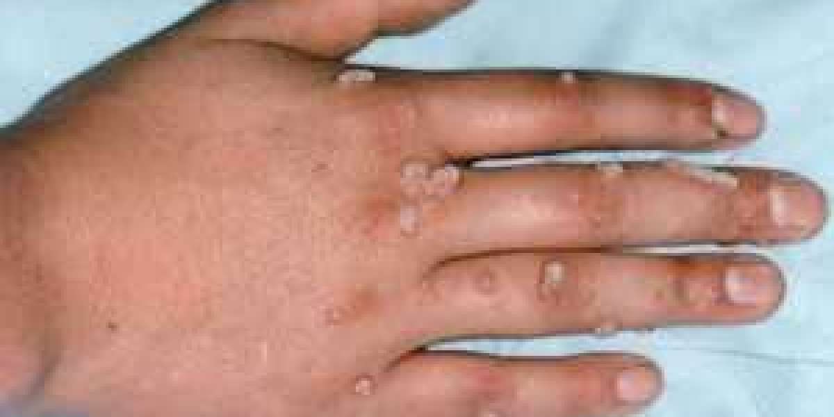 How Warts Are Diagnosed Before Removal in Islamabad: