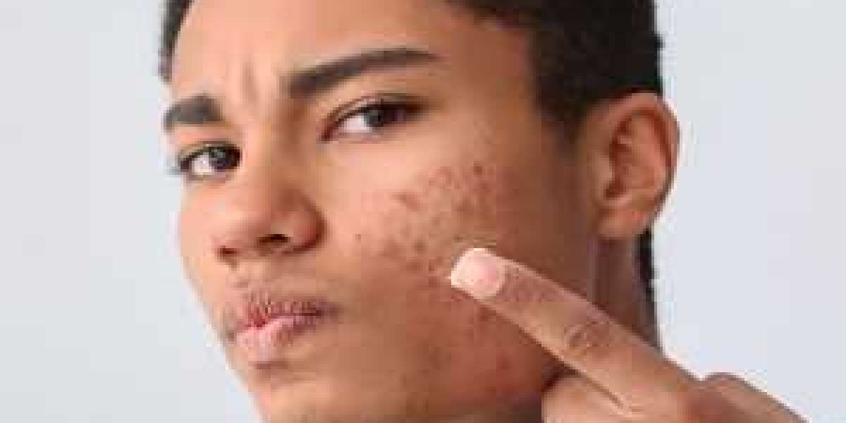 How to Manage Acne Scars Effectively: